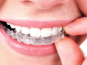 Invisalign Treatment In Bath