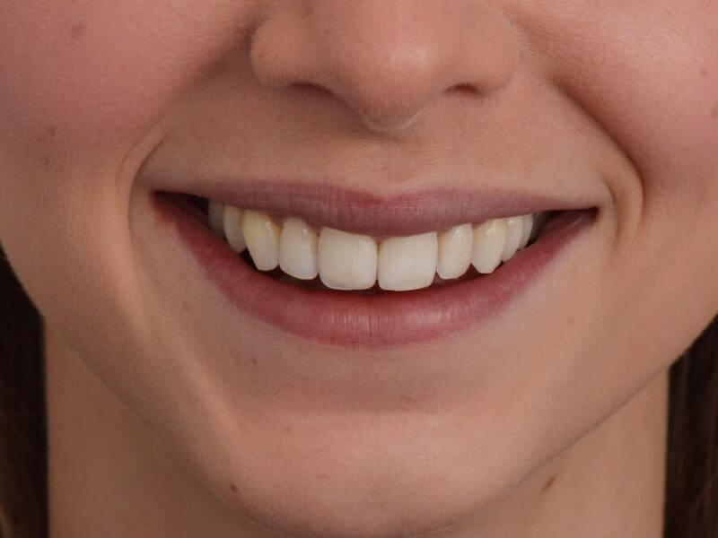 After Invisalign Treatment 2