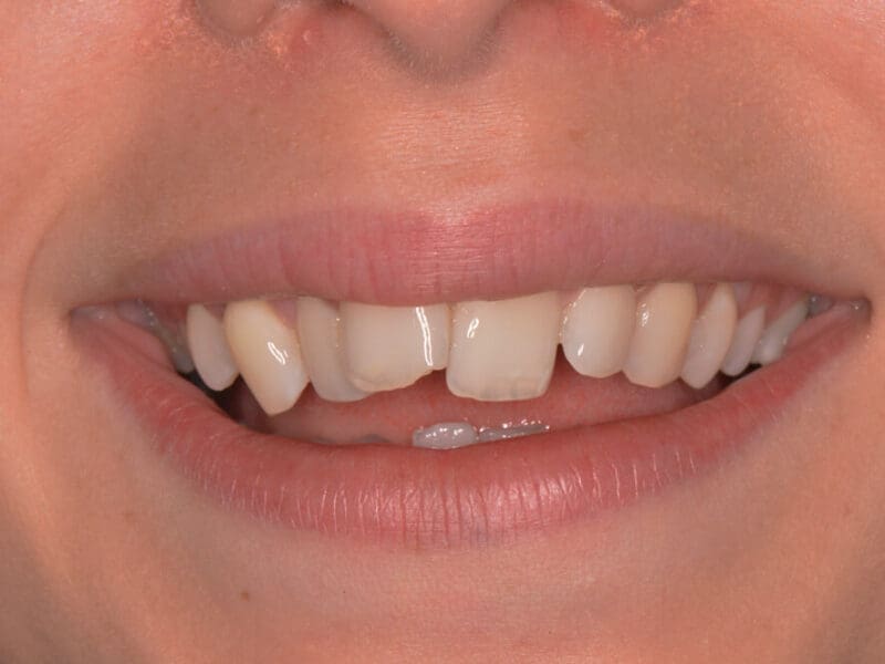 Before Invisalign Treatment 2