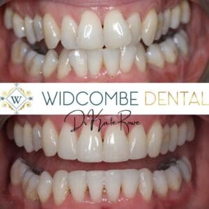 invisalign treatment in bath