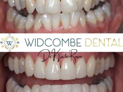 invisalign treatment in bath