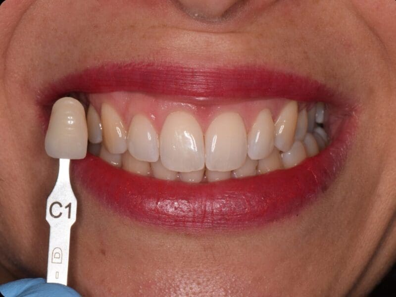 Teeth whitening results at Widcombe Dental Practice