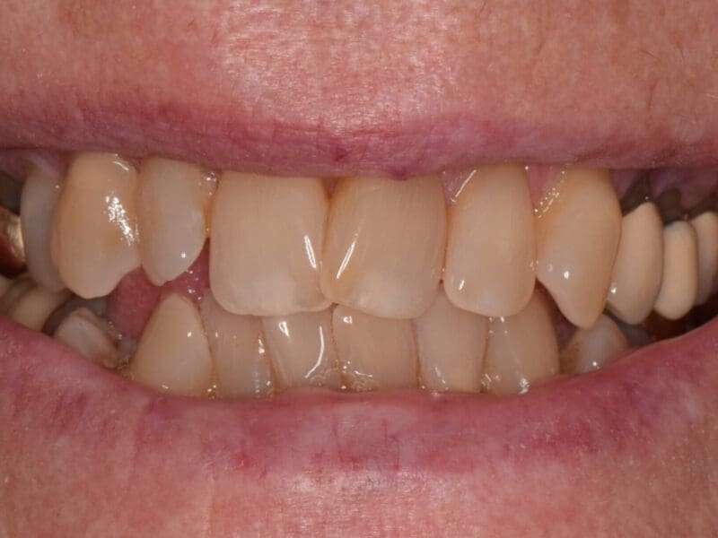 Teeth whitening case study at Widcombe Dental Practice