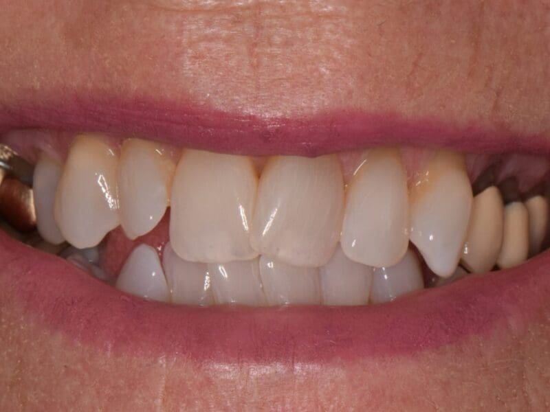 Teeth whitening case study at Widcombe Dental Practice