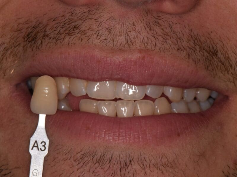 Teeth whitening case study at Widcombe Dental Practice