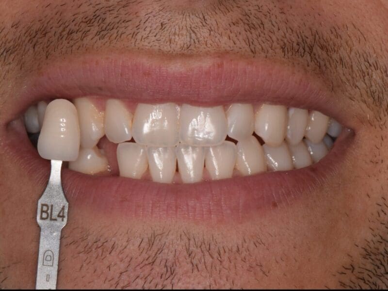 Teeth whitening case study at Widcombe Dental Practice