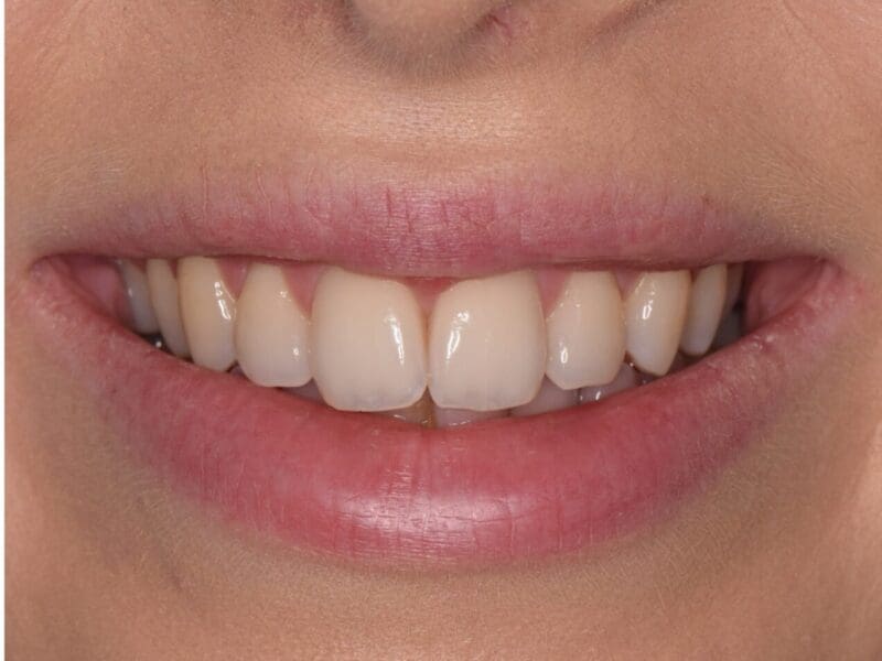 Teeth whitening results at Widcombe Dental Practice