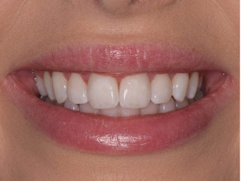 Teeth whitening before and after at Widcombe Dental Practice