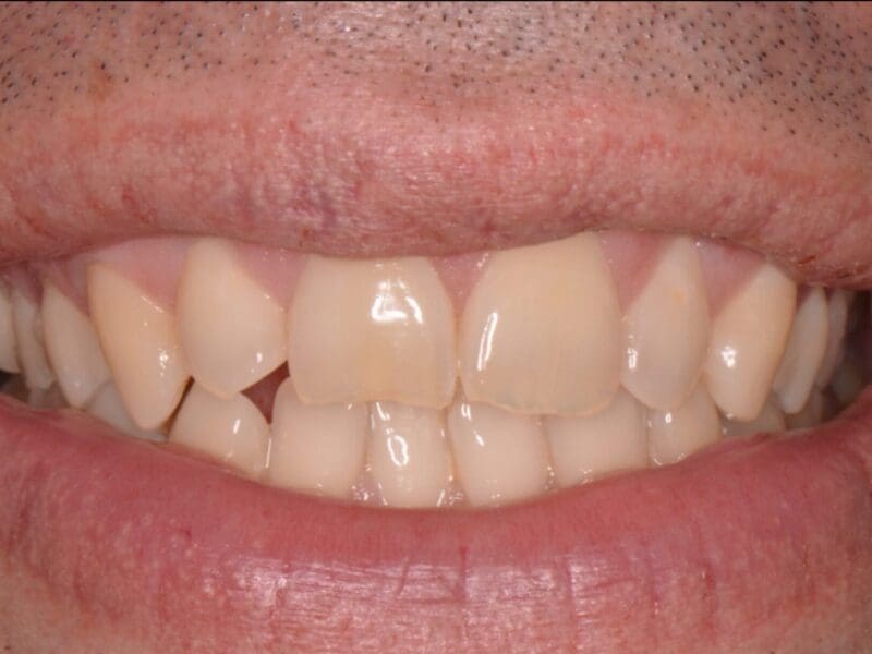 Teeth whitening case study before and after at Widcombe Dental Practice