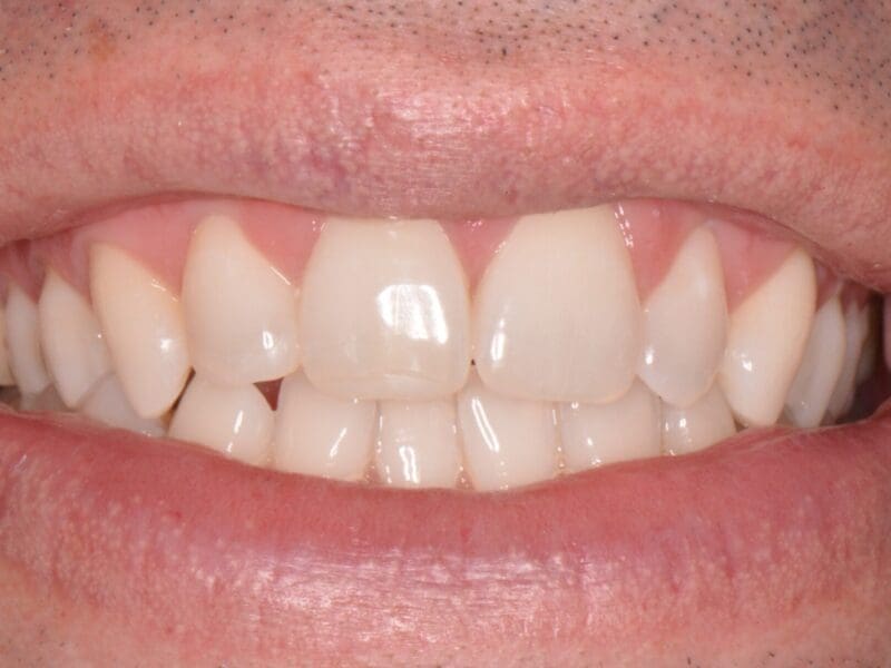 Teeth whitening case study before and after at Widcombe Dental Practice
