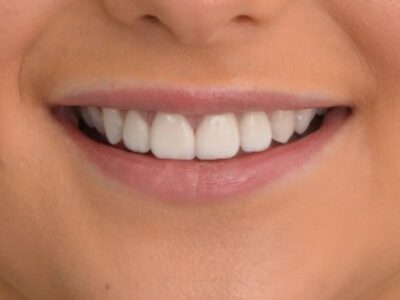 Dental veneers case study at Widcombe Dental Practice