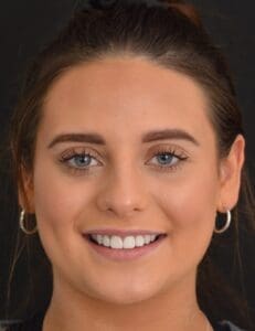 Dental Veneers Ruby