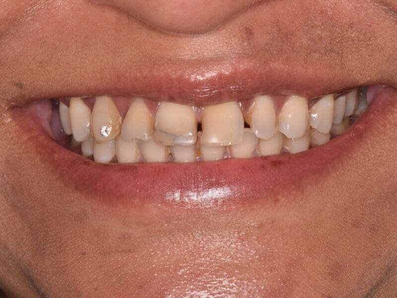Before Invisalign treatment at Widcombe Dental Practice