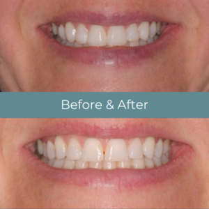 Teeth bonding before and after at Widcombe Dental Practice