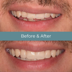 Teeth bonding before and after at Widcombe Dental Practice