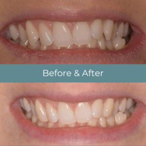 Teeth bonding before and after at Widcombe Dental Practice