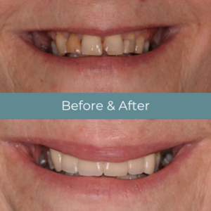 Dental crown before and after at Widcombe Dental Practice