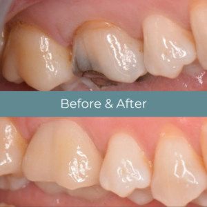 Dental crowns before and after at Widcombe Dental Practice