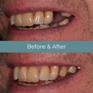 Dentures before and after at Widcombe Dental Practice