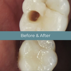 Dental filling before and after at Widcombe Dental Practice