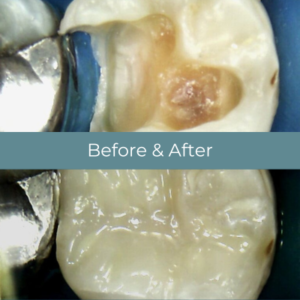 Dental filling before and after at Widcombe Dental Practice