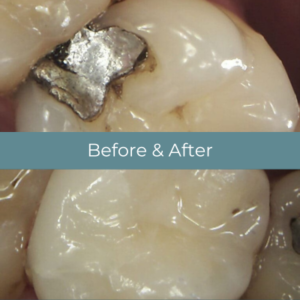 Dental filling before and after at Widcombe Dental Practice
