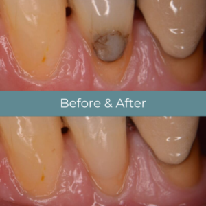 Dental filling before and after at Widcombe Dental Practice
