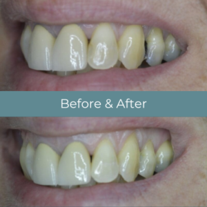 Dental filling before and after at Widcombe Dental Practice