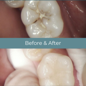 Dental filling before and after at Widcombe Dental Practice