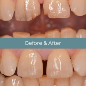 Dental filling before and after at Widcombe Dental Practice