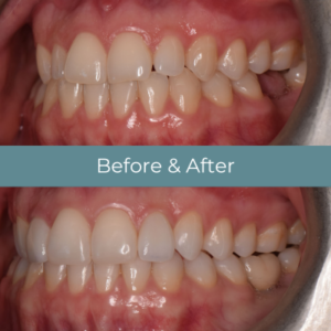 Dental implants before and after at Widcombe Dental Practice