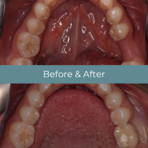 Dental implants before and after at Widcombe Dental Practice