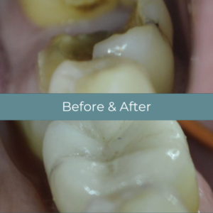 Dental inlays before and after at Widcombe Dental Practice