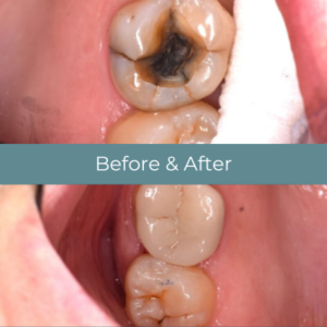Dental inlays before and after at Widcombe Dental Practice