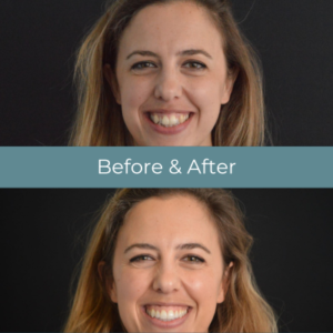 Invisalign before and after treatment at Widcombe Dental Practice