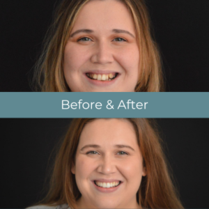 Invisalign before and after treatment at Widcombe Dental Practice