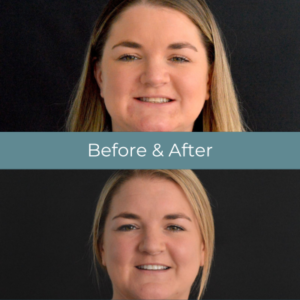 Invisalign before and after treatment at Widcombe Dental Practice