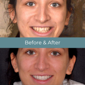 Invisalign before and after treatment at Widcombe Dental Practice