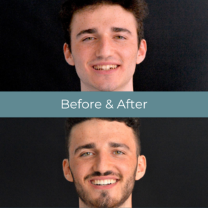 Invisalign treatment results at Widcombe Dental Practice