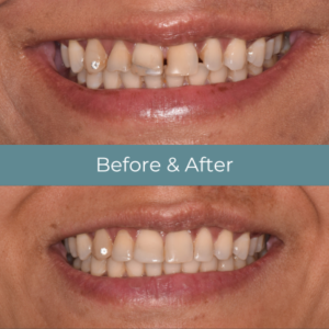 Invisalign before and after treatment at Widcombe Dental Practice