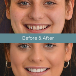 Smile design before and after treatment at Widcombe Dental Practice