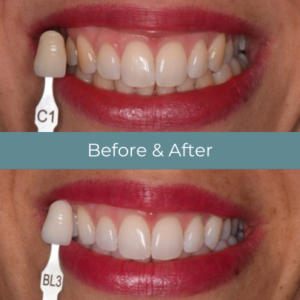 teeth whitening case study