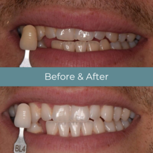 Teeth whitening before and after at Widcombe Dental Practice