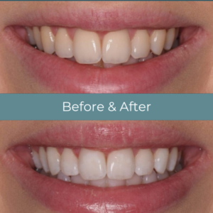 Teeth whitening before and after at Widcombe Dental Practice