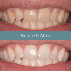 Teeth whitening before and after at Widcombe Dental Practice