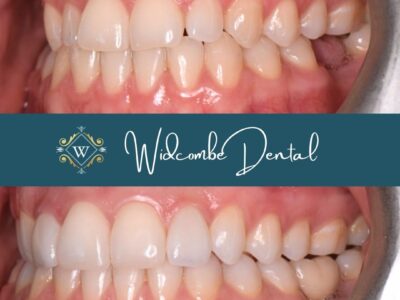 Dental Implant Before and After