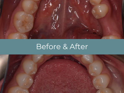 Implants top teeth before and after