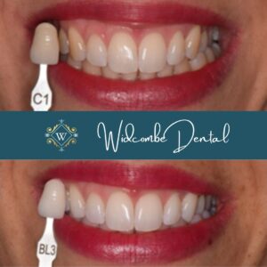 Teeth whitening before and after image