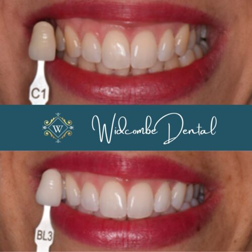 Teeth whitening before and after image