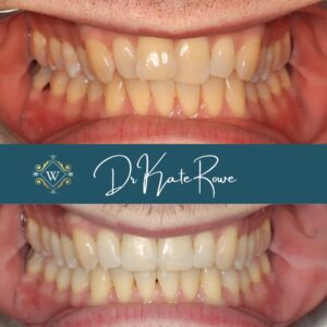 Invisalign results from Dr Kate Rowe